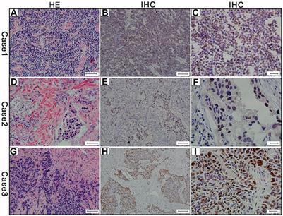 MYCL1 Amplification and Expression of L-Myc and c-Myc in Surgically Resected Small-Cell Lung Carcinoma